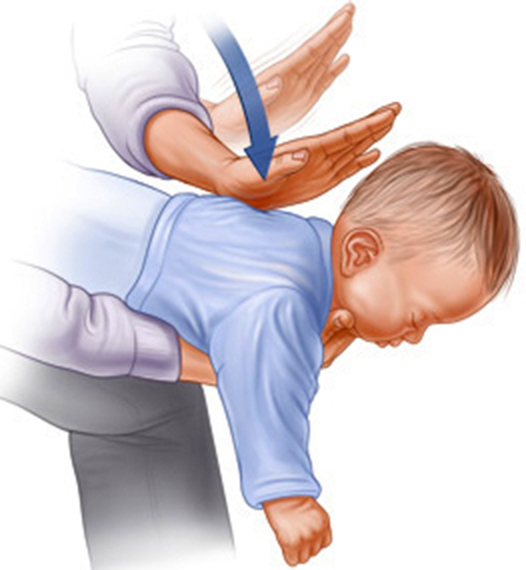 bambino-manovra-heimlich.jpg
